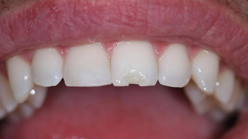 Nên làm gì khi răng sứ bị mẻ?