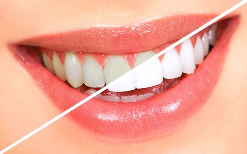 Tẩy trắng răng có làm hỏng men răng không? Các cách tẩy trắng răng