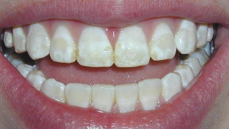 Răng bị đốm trắng do lớp men răng bên ngoài bị mòn hoặc bị thiếu, mỏng đi.