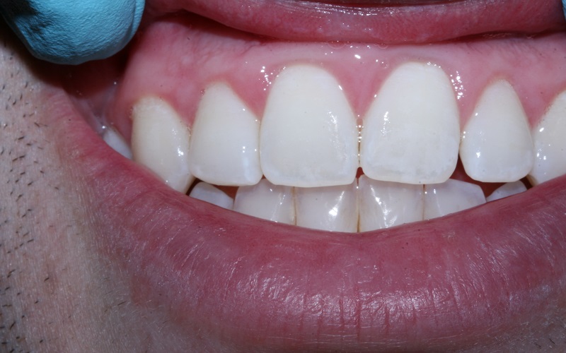 Tẩy nhẹ lớp men răng (Microabrasion)