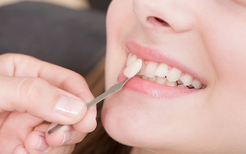 Sử dụng Veneer nha khoa để che đi khuyết điểm và cải thiện vẻ ngoài của răng