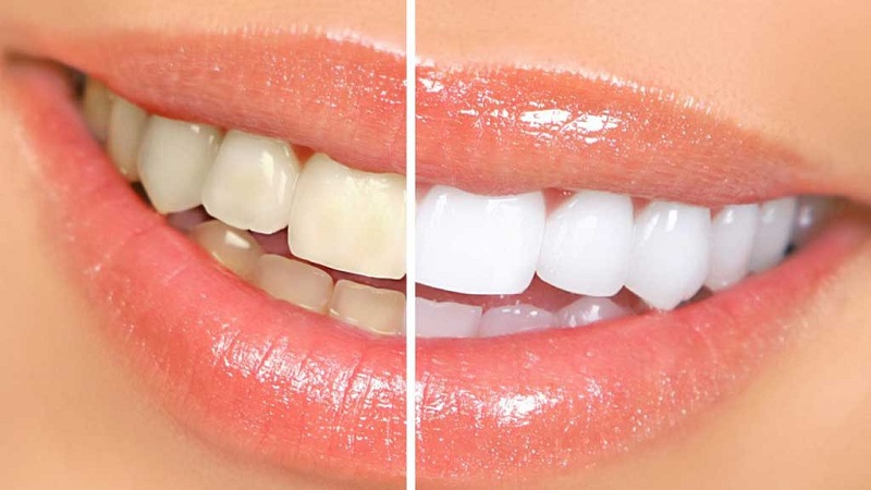 Tẩy trắng răng cũng là cách giúp hàm răng trắng sáng nhanh chóng,