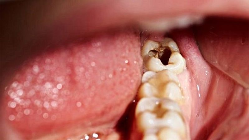 Răng khôn bị sâu vì sao? Nên làm gì khi răng khôn bị sâu?