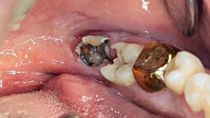 Hậu quả của việc răng khôn bị sâu