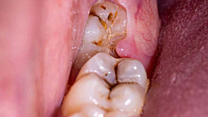 Cách xử lý và chăm sóc khi răng khôn bị sâu