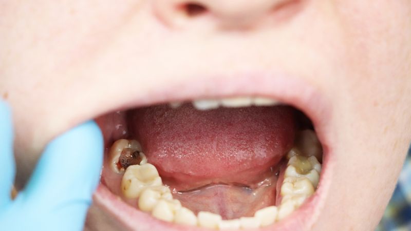  Cách phòng ngừa sâu răng khôn