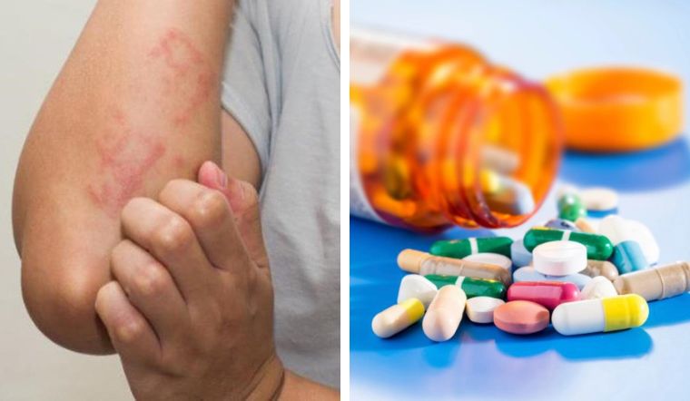 Dị ứng thuốc kháng sinh vì sao? Nên làm gì khi dị ứng thuốc kháng sinh