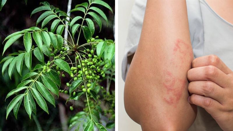 What is poison sumac allergy? Causes and prevention of allergies