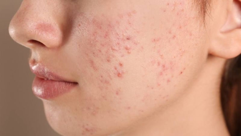 Using treatment products can cause skin irritation