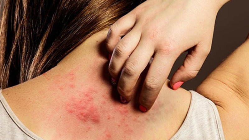 What is Psoriasis? Causes and prevention of psoriasis