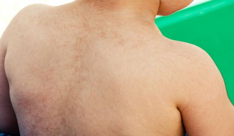 Đừng chủ quan khi con mắc phải chứng rậm lông, hãy đưa bé đi khám ngay