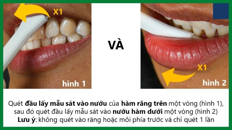 Dùng đầu lấy mẫu quét vào nước hàm trên một vòng, nướu hàm dưới một vòng