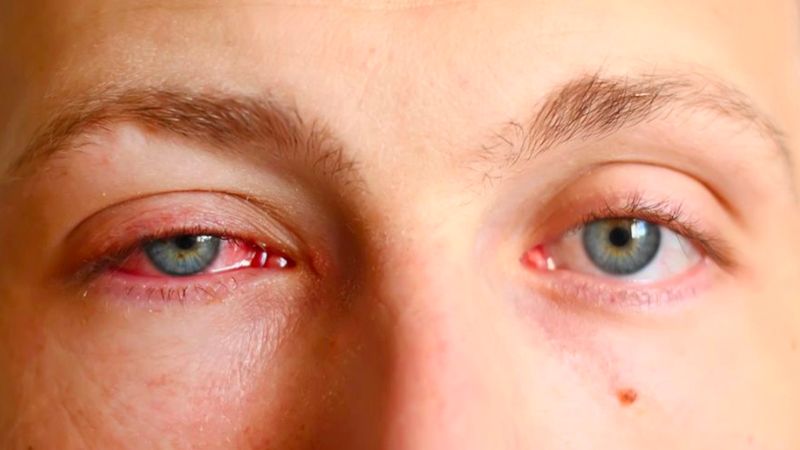 Dấu hiệu đau mắt hàn