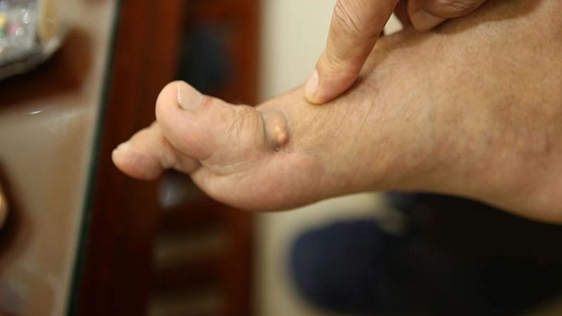 Nguy cơ mắc bệnh gout