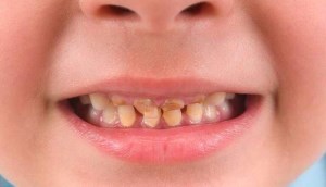Vì sao có tình trạng răng trẻ bị đen khi uống sắt nước?