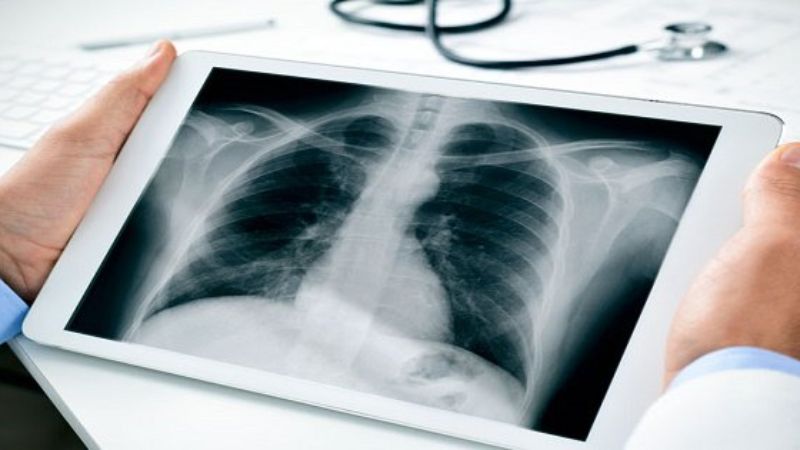 Chụp X-quang là gì? Những điều cần biết về chụp X-quang