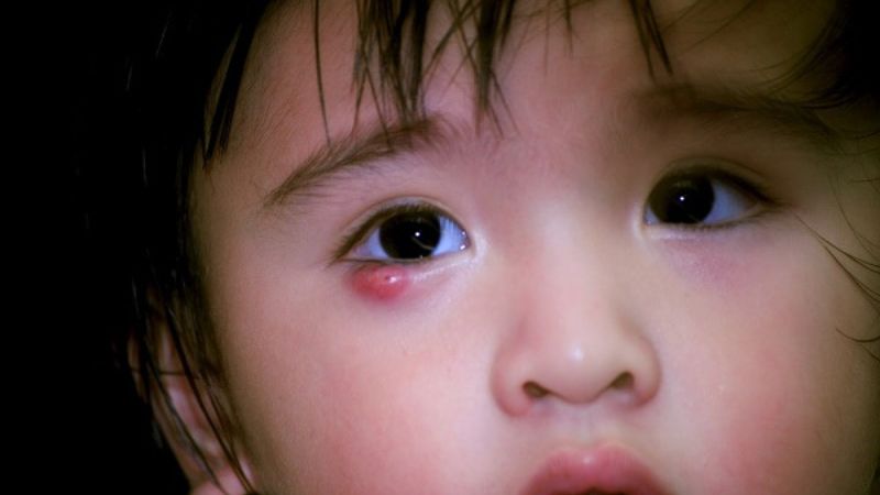 Nguyên nhân và cách chăm sóc tại nhà khi trẻ bị viêm bờ mi mắt