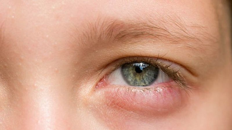 Triệu chứng viêm bờ mi mắt ở trẻ