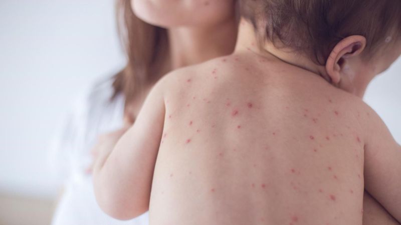 Bệnh thủy đậu Bệnh thủy đậu