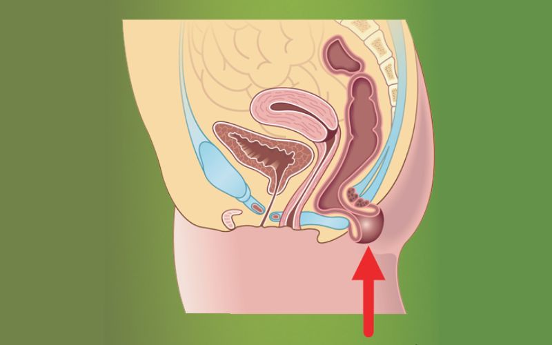 Mức độ nguy hiểm của sa tử cung sau sinh