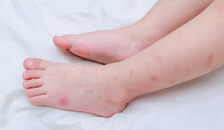 Nguyên nhân và cách giải quyết khi trẻ bị nổi mẩn đỏ như muỗi đốt 