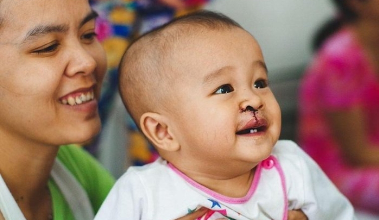 Chăm sóc con yêu trước và sau khi phẫu thuật khe hở môi 