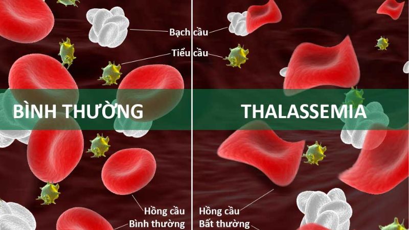 Trẻ thiếu máu nhưng thừa chất do căn bệnh Thalassemia