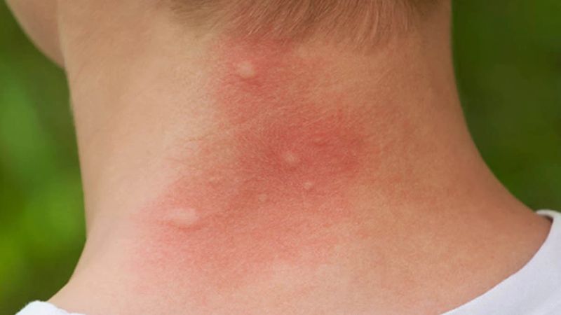 Sự nguy hiểm của vết đốt từ muỗi, côn trùng