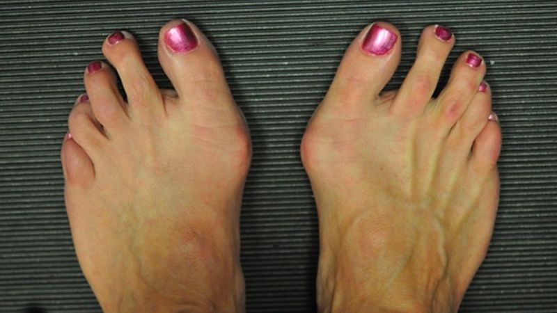 Ngón chân cái biến dạng là hậu quả của việc mang giày cao gót thường xuyên