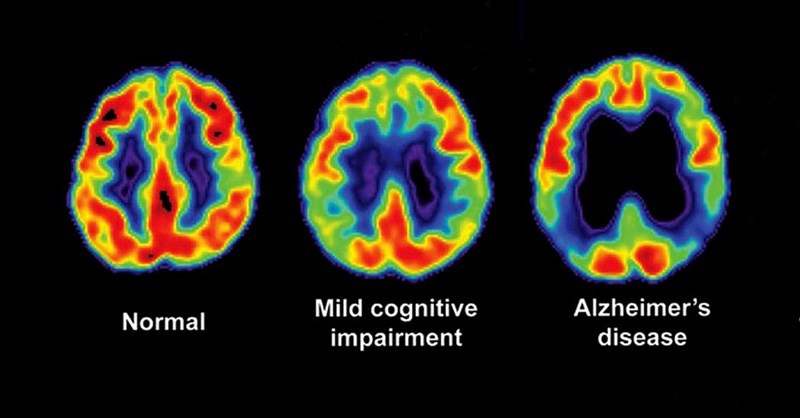 Samsung hỗ trợ chẩn đoán Alzheimer