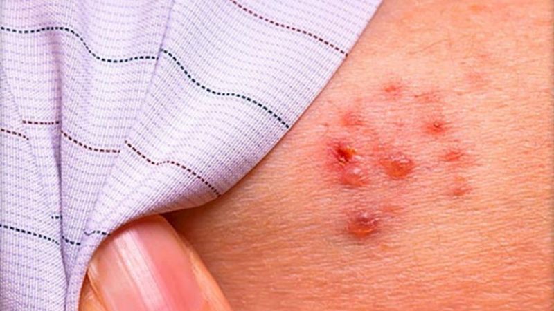 What is shingles in children? How is shingles diagnosed?