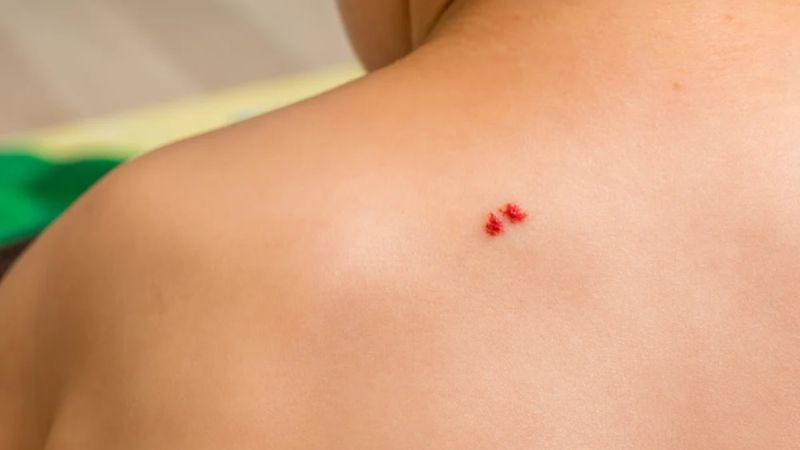 What is a lipstick mole? Is it okay to have a lot of moles on the skin?