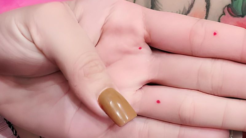 The cause of the growth of a lip mole is still unknown