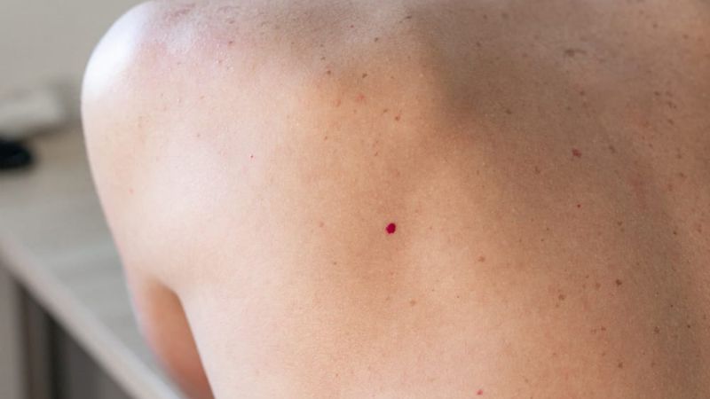 Đây là một trường hợp lành tính trên da chỉ ảnh hưởng về mặt thẩm mỹ