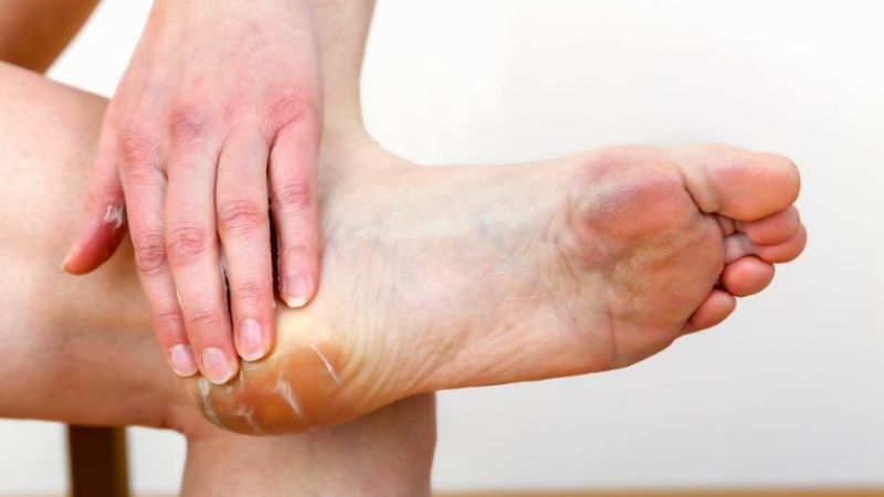 Gót chân bị nứt nay đã có cách chữa hiệu quả từ mỡ trăn