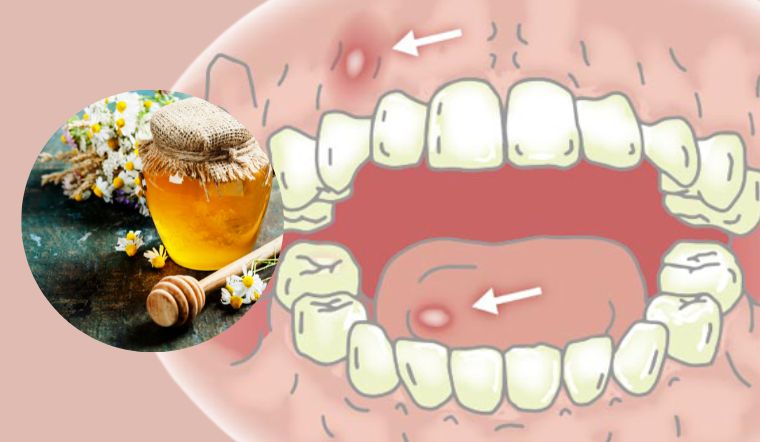 3 cách chữa nhiệt miệng bằng mật ong đơn giản, hiệu quả