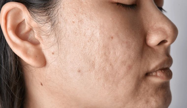 Sẹo lõm là gì? Tìm hiểu các cách trị sẹo lõm an toàn hiện nay