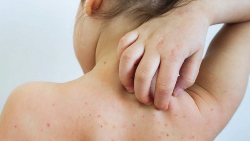 Mẹ đang mang bầu nhiễm vi rút Rubella có nguy hiểm cho thai nhi?