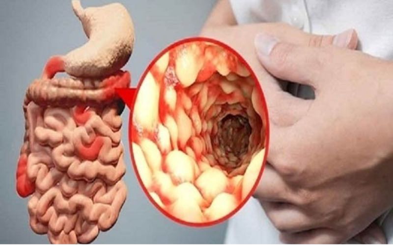 Bệnh Crohn