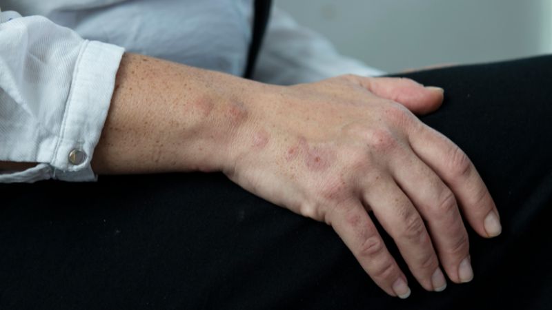 Bite marks from bedbugs on the skin