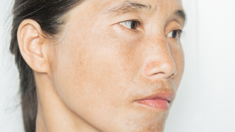Image of Uneven Skin Tone