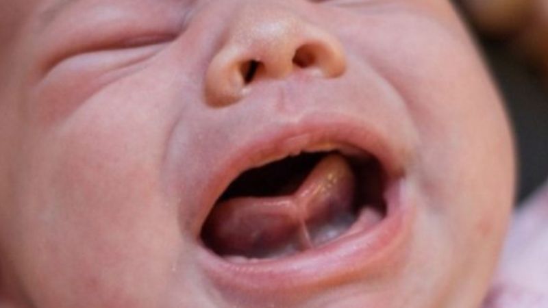 Bé bị tật dính thắng lưỡi Bé bị tật dính thắng lưỡi