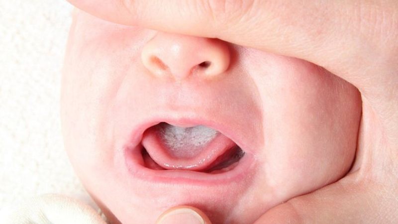 Bé bị nấm miệng Bé bị nấm miệng