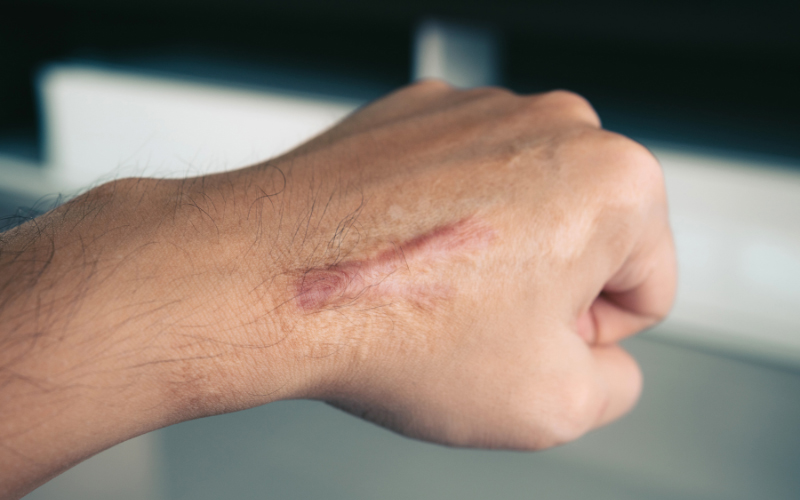 Chưa có nghiên cứu chứng minh rau muống gây sẹo lồi Chưa có nghiên cứu chứng minh rau muống gây sẹo lồi