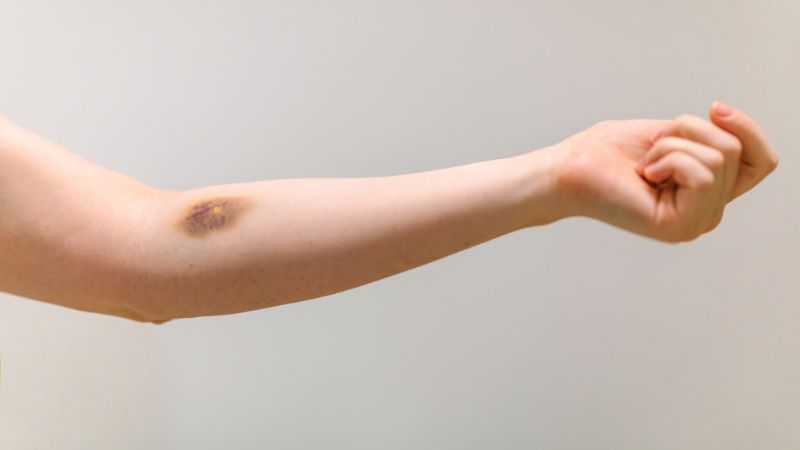 Trẻ có vết bầm tím liên quan đến một số bệnh lý