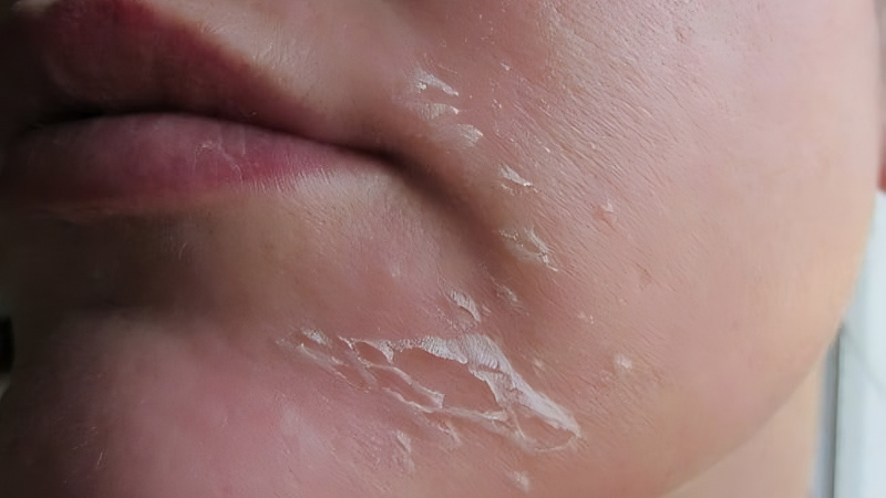 Ensure proper skin peeling technique