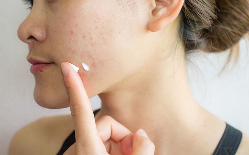Apply acne treatment cream before applying sunscreen