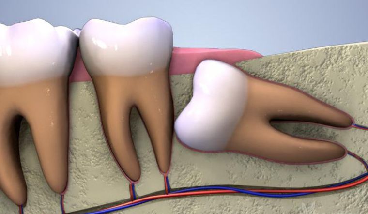30 tuổi mọc răng khôn nên nhổ hay không? Có đau không?