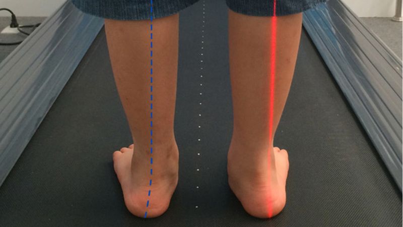 Lợi ích các bài tập hỗ trợ điều trị bàn chân bẹt Lợi ích các bài tập hỗ trợ điều trị bàn chân bẹt