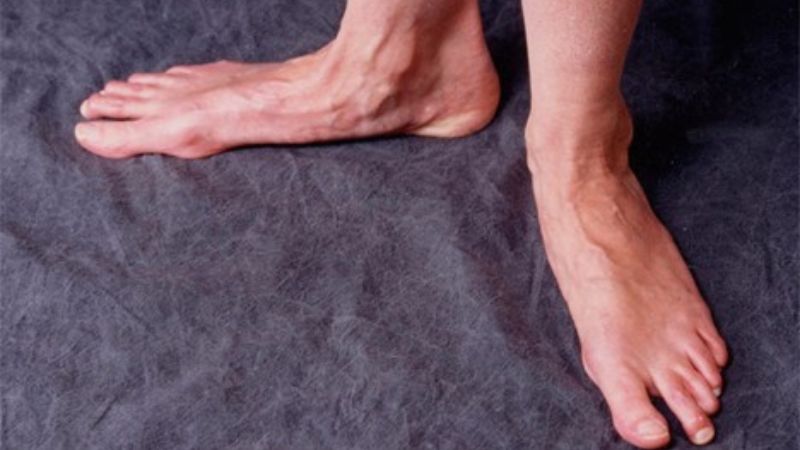 Lưu ý khi thực hiện bài tập cho bàn chân bẹt Lưu ý khi thực hiện bài tập cho bàn chân bẹt